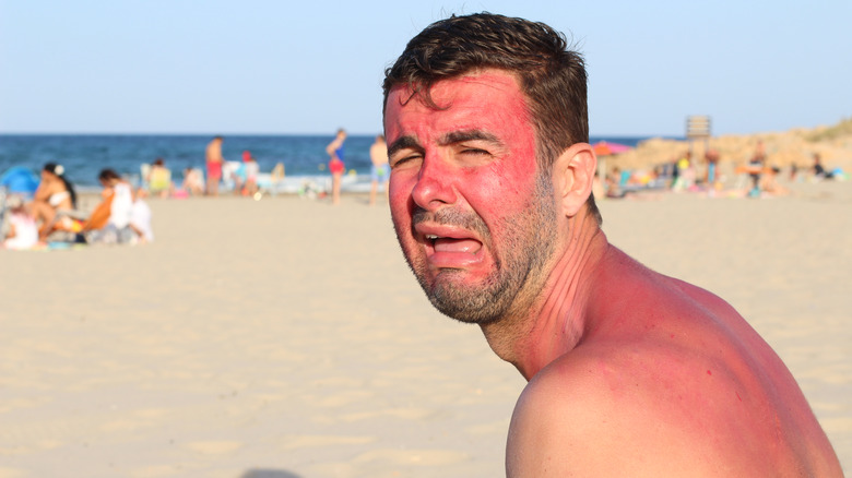 Man with sunburn at beach