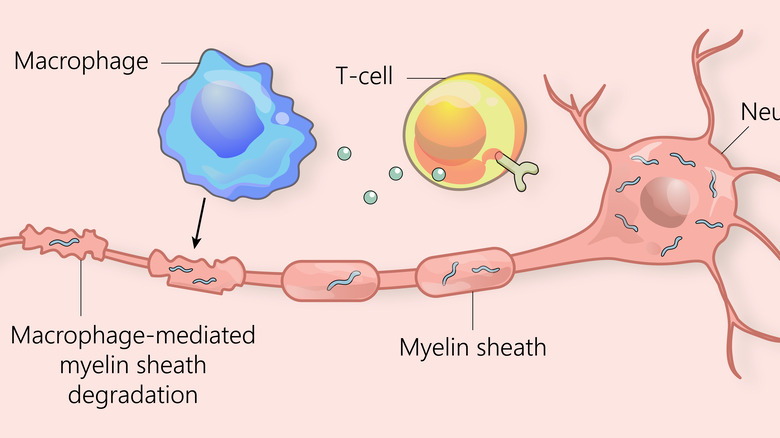 multiple sclerosis graphic