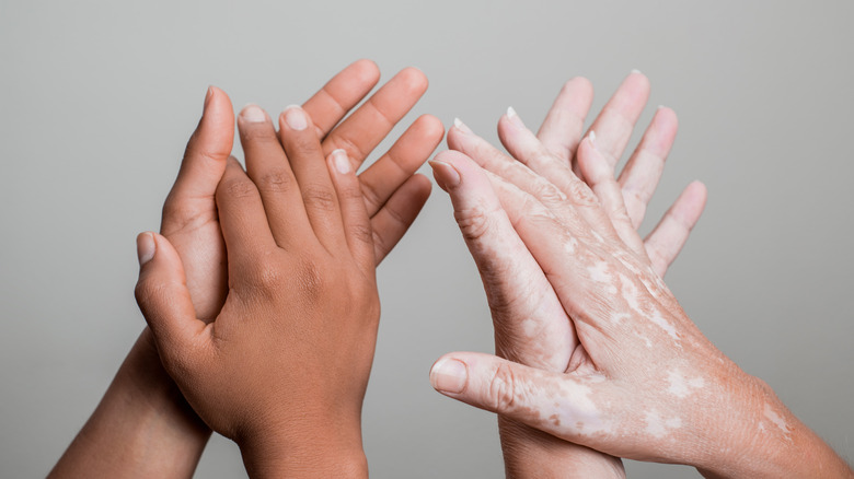 two sets of hands with one showing vitiligo