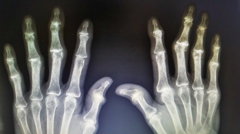 X-ray of rheumatoid arthritis patient's hands