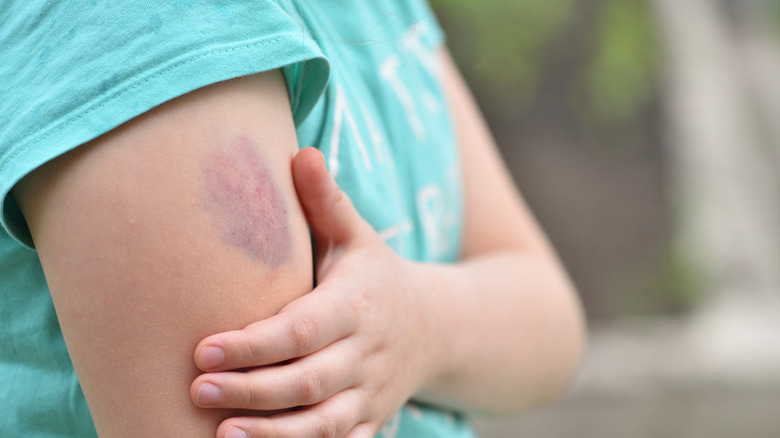 Person holding their bruised left arm