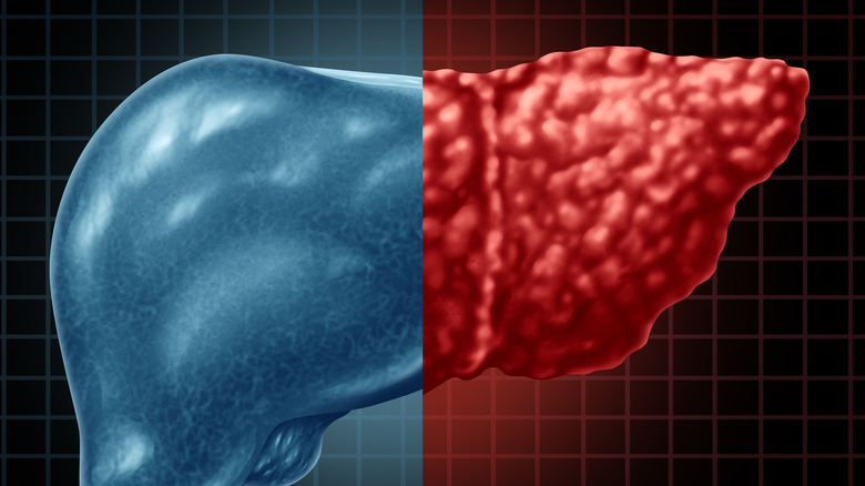 concept of fatty liver disease