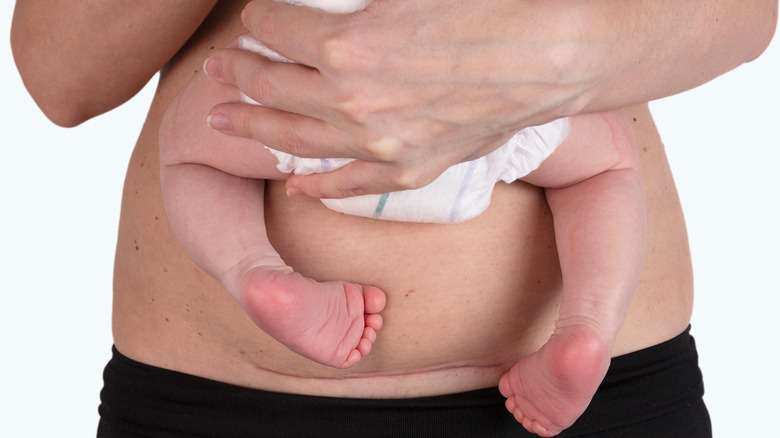 Woman holding a baby with a C-section scar 