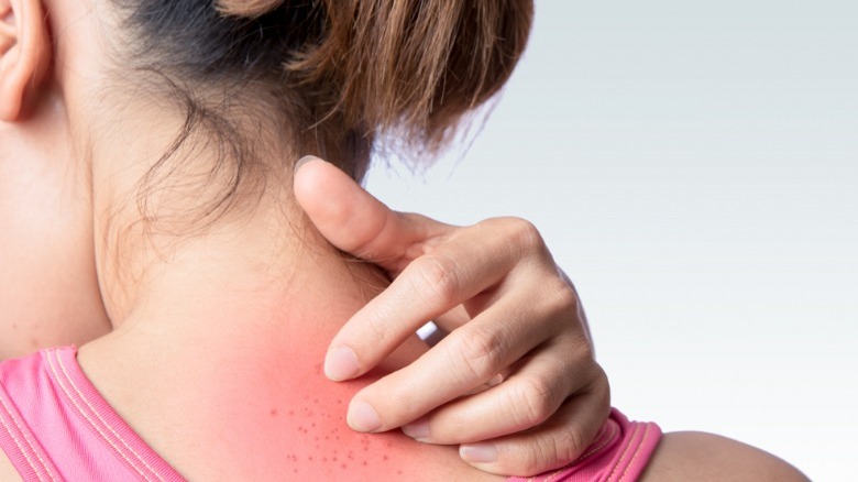 woman with neck rash