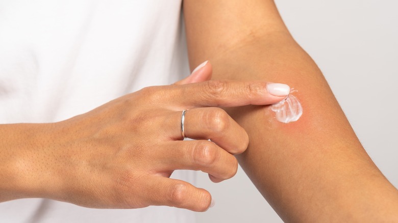 woman rubbing lotion on her rash