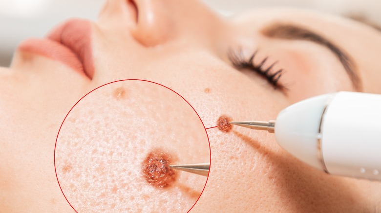 laser removal of a mole