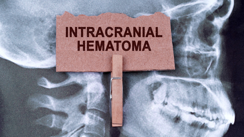 intracranial hematoma