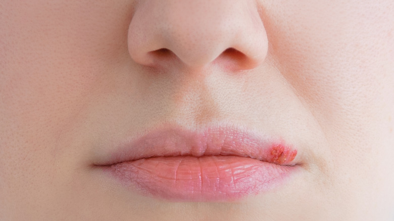 Person with cold sore on their lip