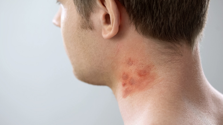 Man with contact dermatitis on the neck