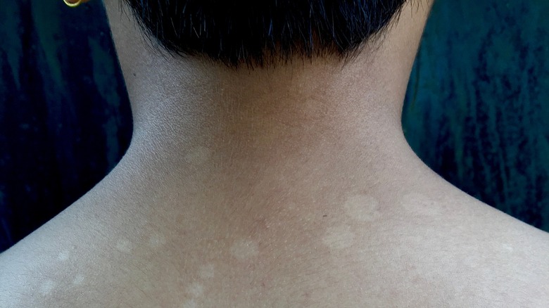 man with tinea versicolor neck rash discoloration
