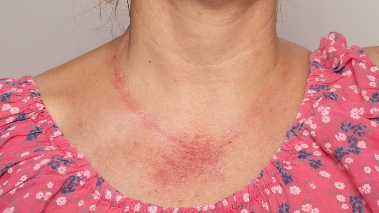 woman with neck rash from jewelry