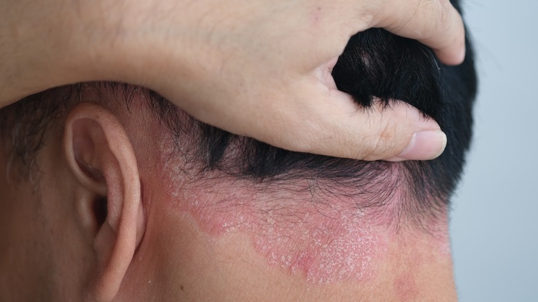 Psoriasis on the back of a man's neck