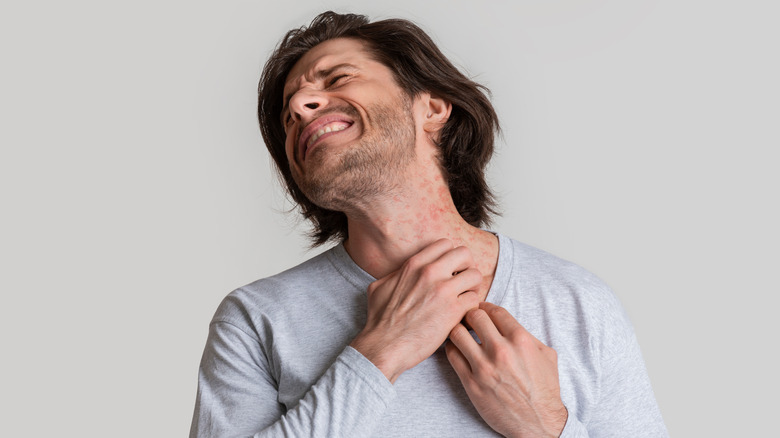 Man with stress-induced neck rash