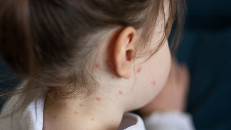 girl with measles rash on the face and neck