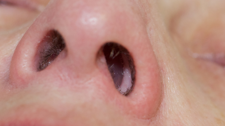 nasal polyp inside nose
