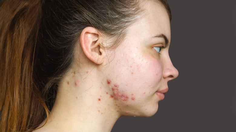 girl with keloid scar on chin
