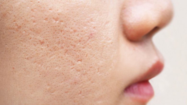 woman with ice pick acne scars