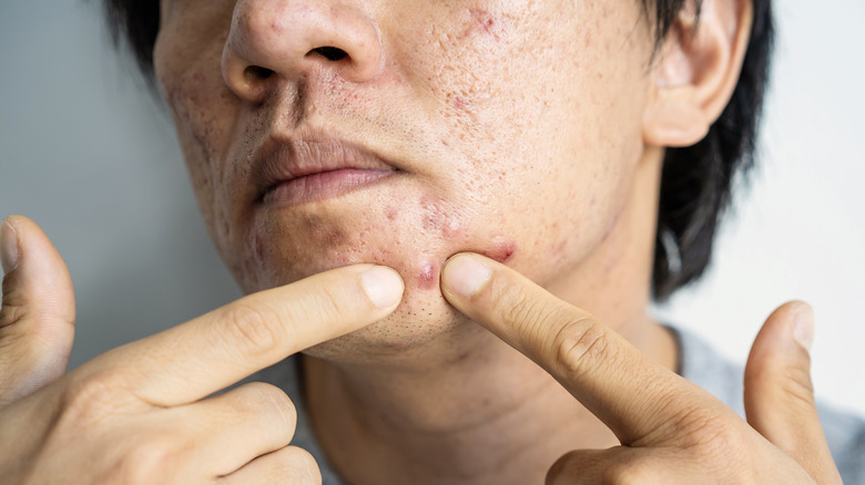 man with atrophic acne scars