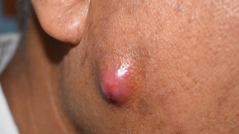 Person with nodular acne bump