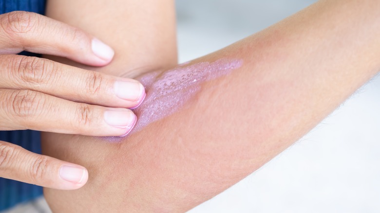 Hand applying calamine lotion