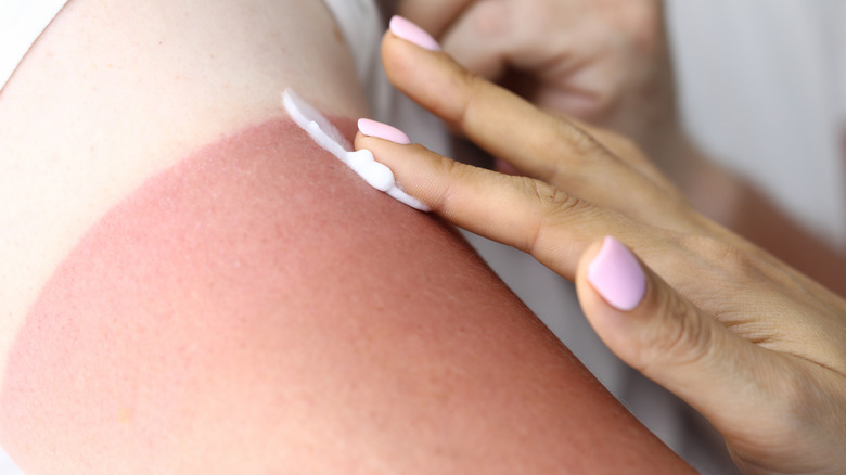 Applying lotion to a sunburn on shoulder
