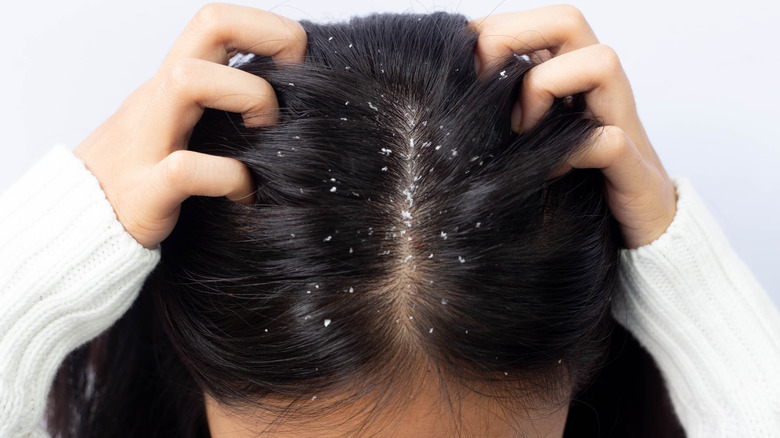 head with dandruff