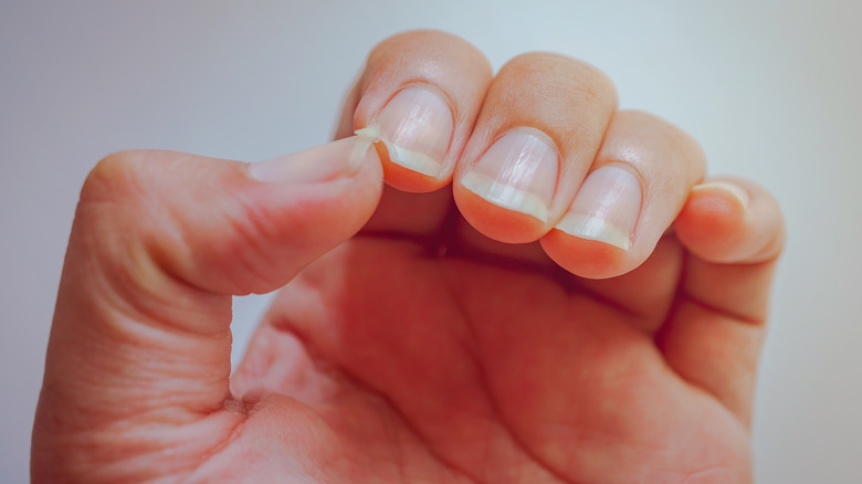 Closeup of torn nail