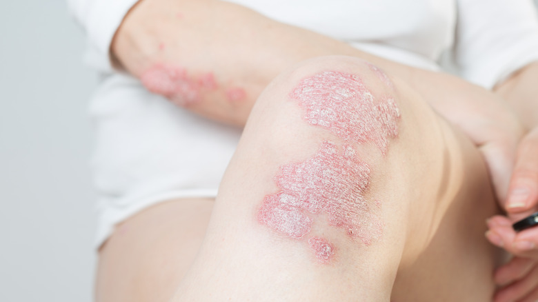 psoriasis affecting the knee
