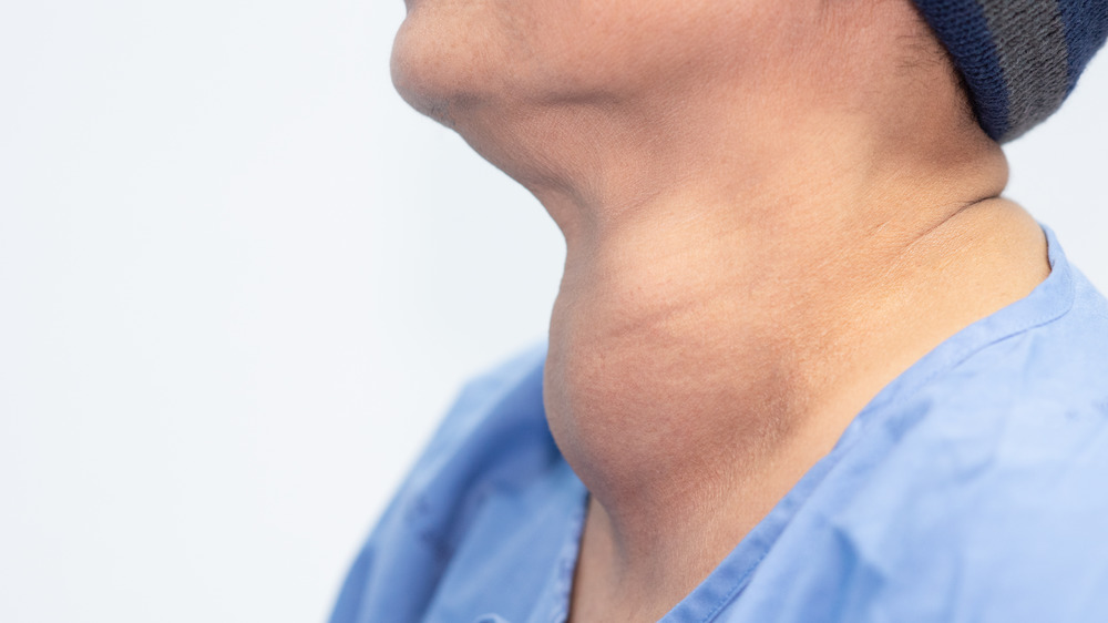 Enlarged thyroid gland on neck