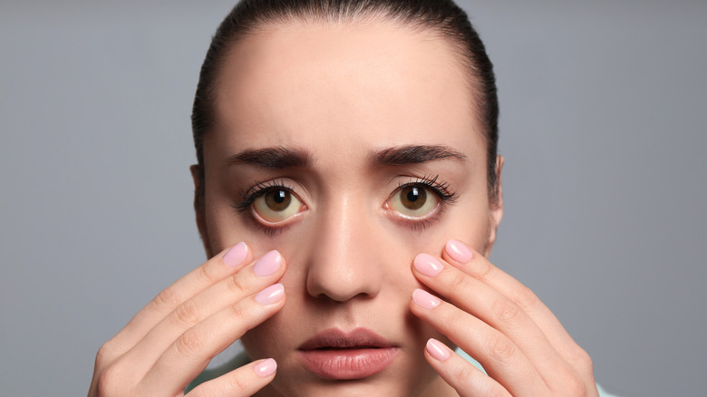Woman pulling skin under jaundiced eyes
