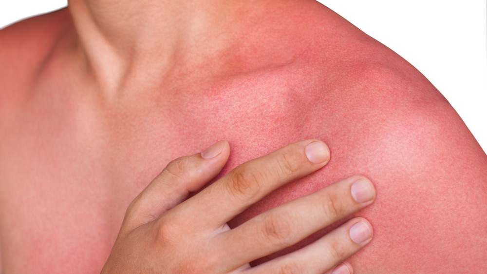 Close up of a man with a sunburn touching his arm and chest.
