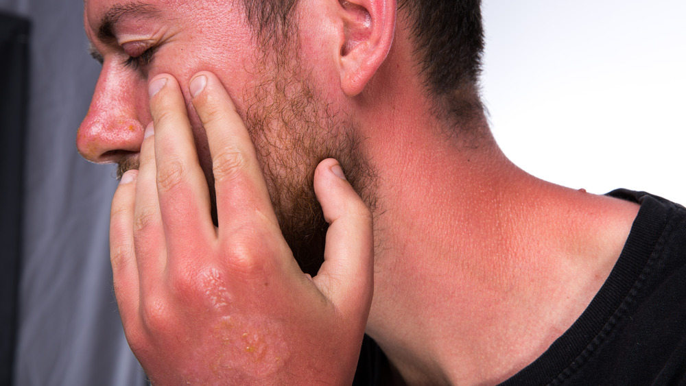 Man with a bad sunburn touching his face with his blistered hand