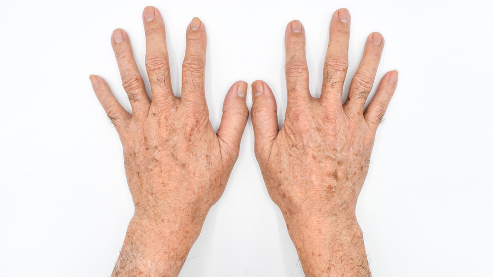 Close up of two hands that have liver spots against a white background.