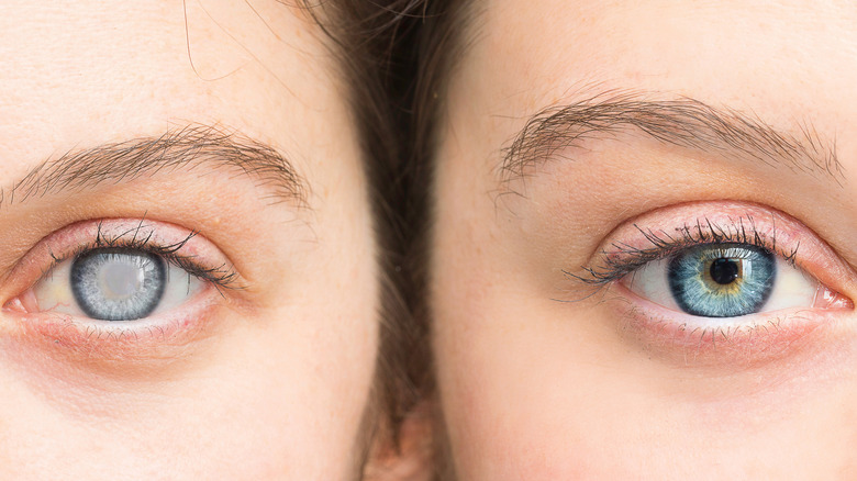 Close-up comparison of person with clouded eye and healthy eye