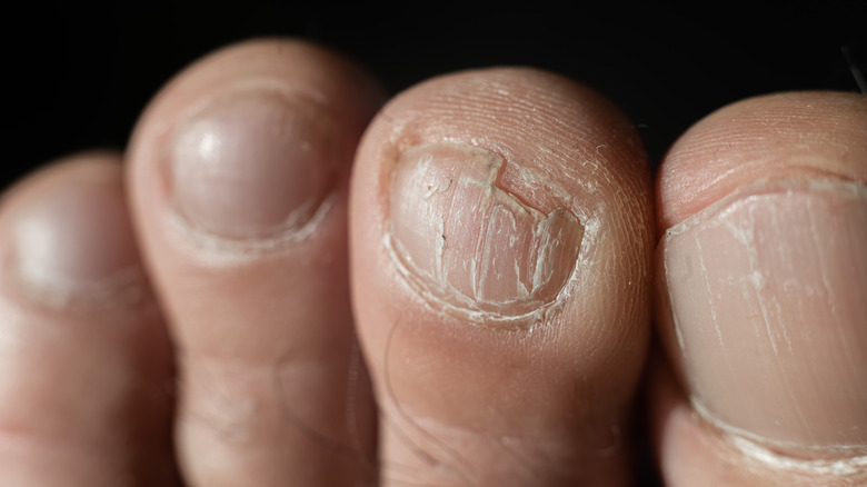 Close up of male broken toe nail