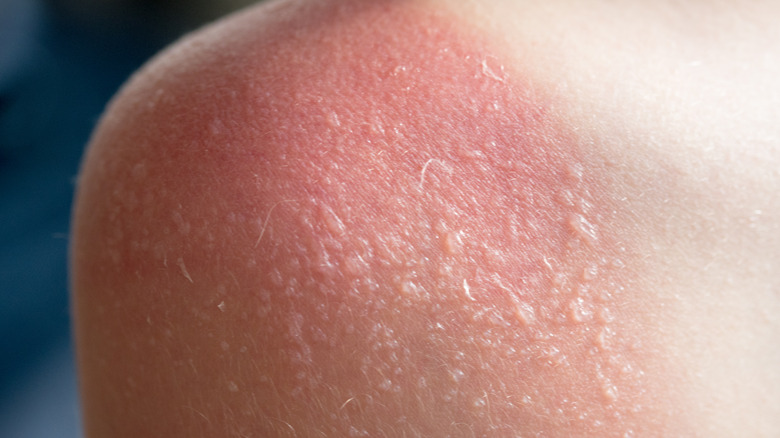 If You Get Sunburn Blisters Here s What You Should Do