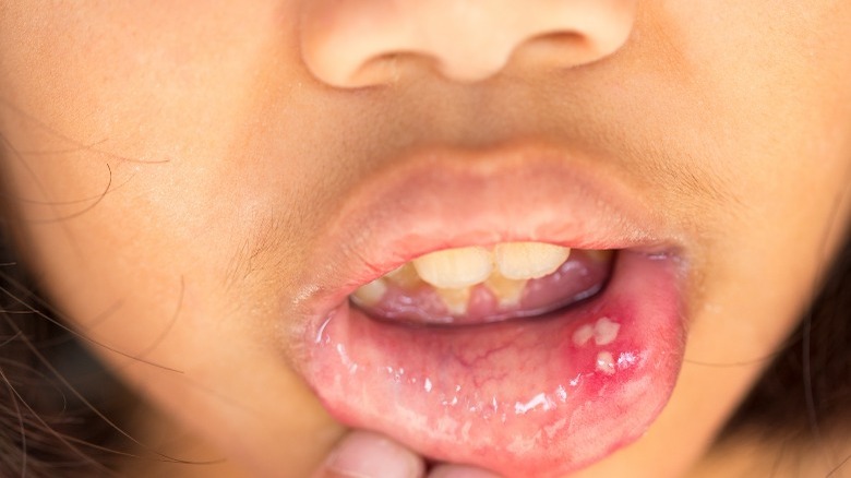 person with mouth sores 