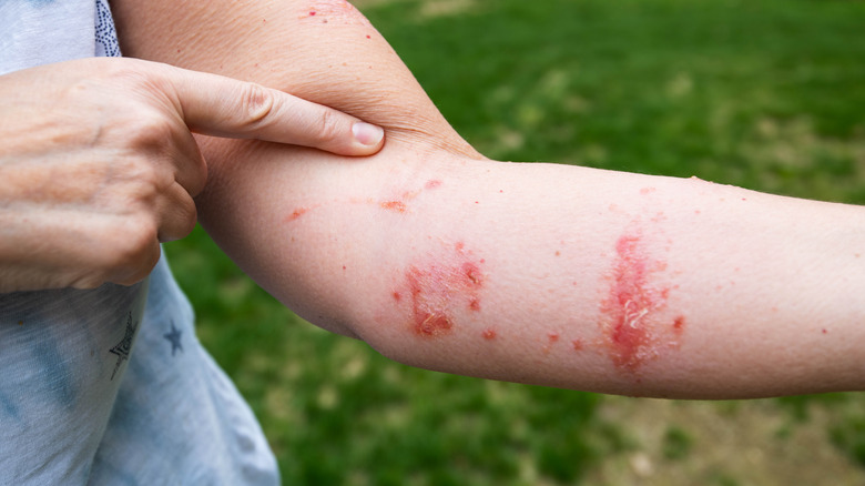 poison ivy rash on hand