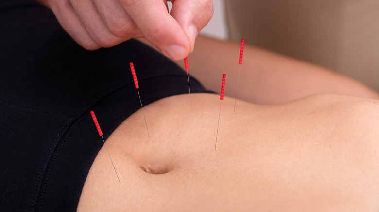 acupuncture needles in female abdomen