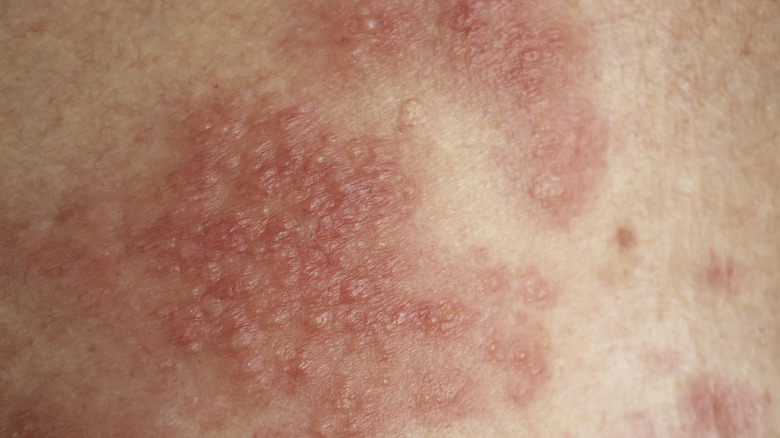 eczema rash