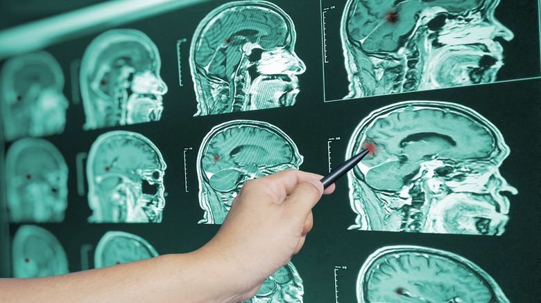 A doctor looks at a brain scan