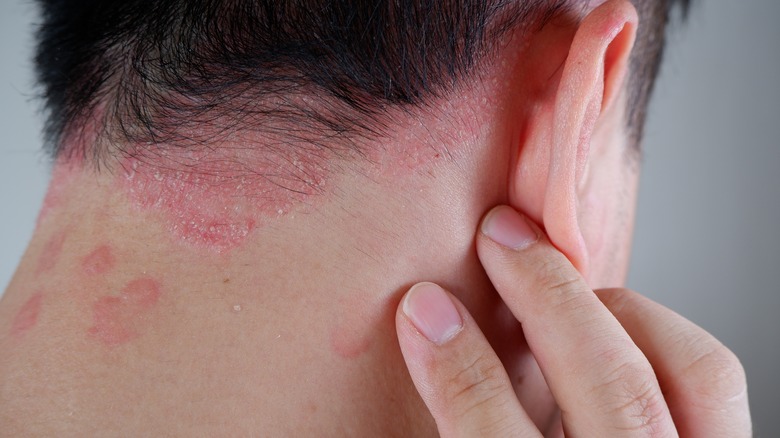 Man with psoriasis on neck