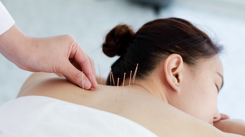 woman undergoing acupuncture treatment