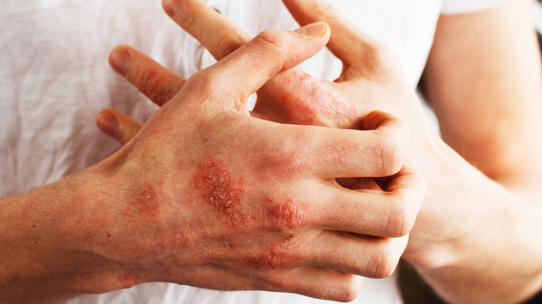 psoriasis patches on hands