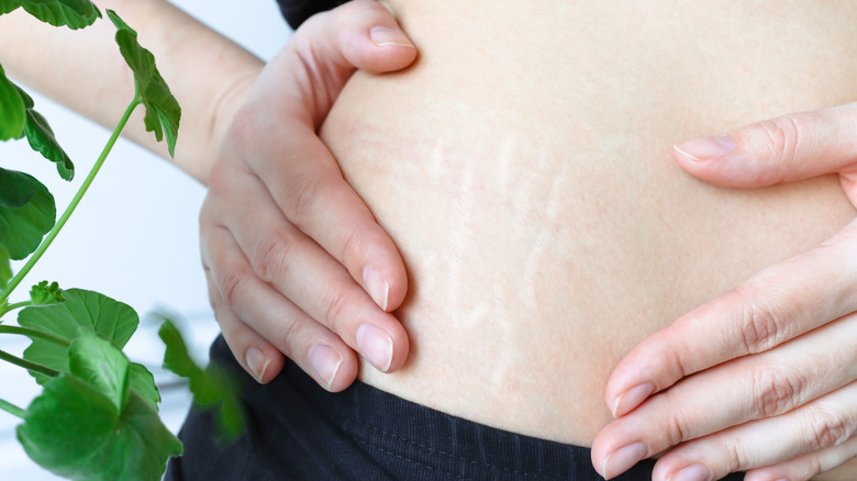 Close-up of stretch marks on woman's abdomen
