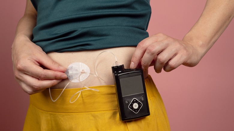 A diabetic with insulin pump