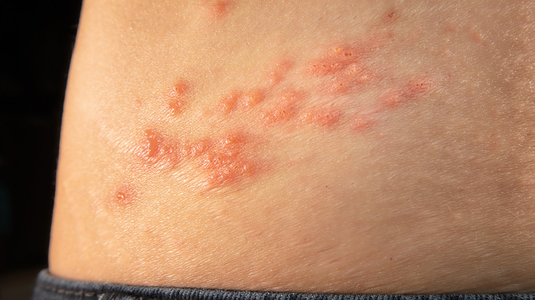 shingles rash