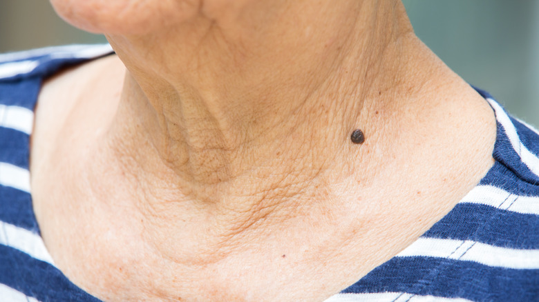 An older woman with a mole on neck