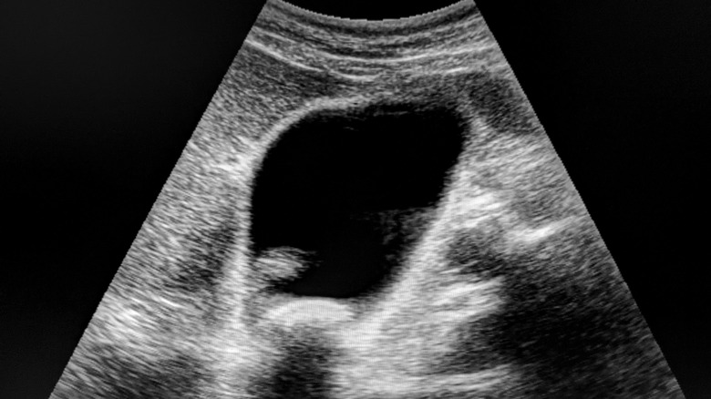 Ultrasound of gallstones