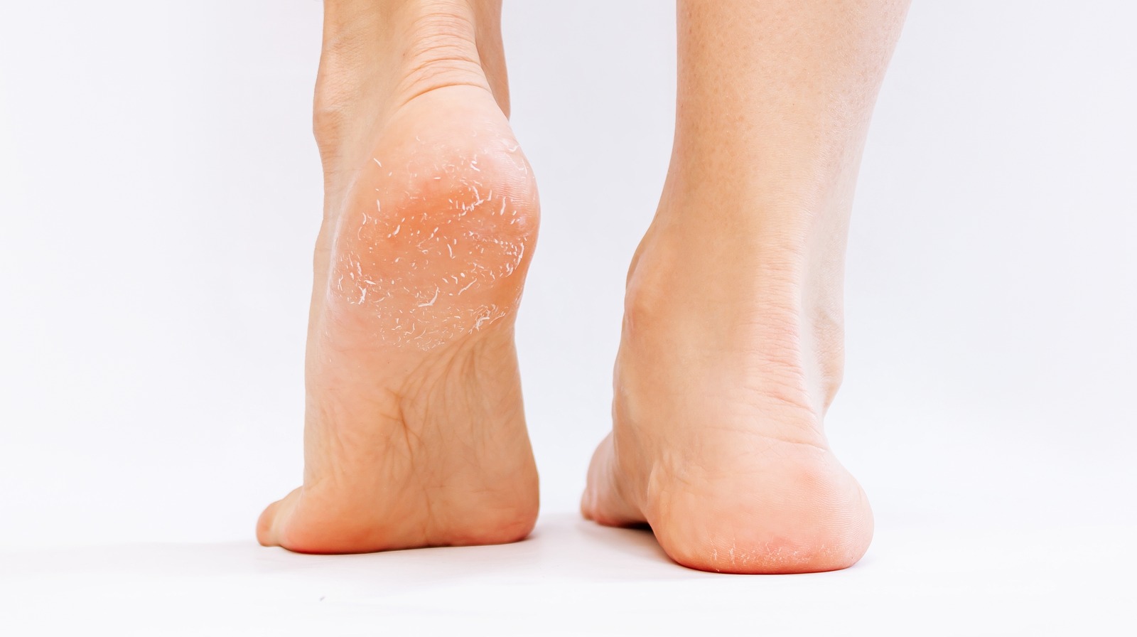 Dry Skin Peeling Off Feet 2024